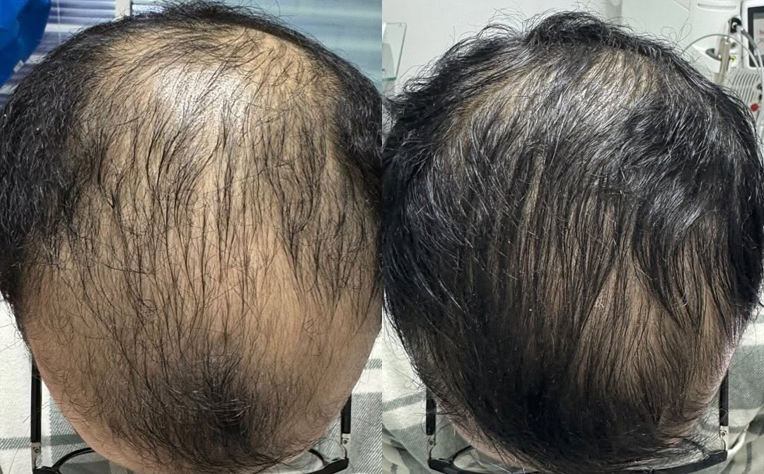 Advance Regenesis Organic Hair Oil For Hairfall & Dandruff