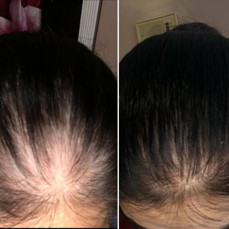 Advance Regenesis Organic Hair Oil For Hairfall & Dandruff - Mairaj Care